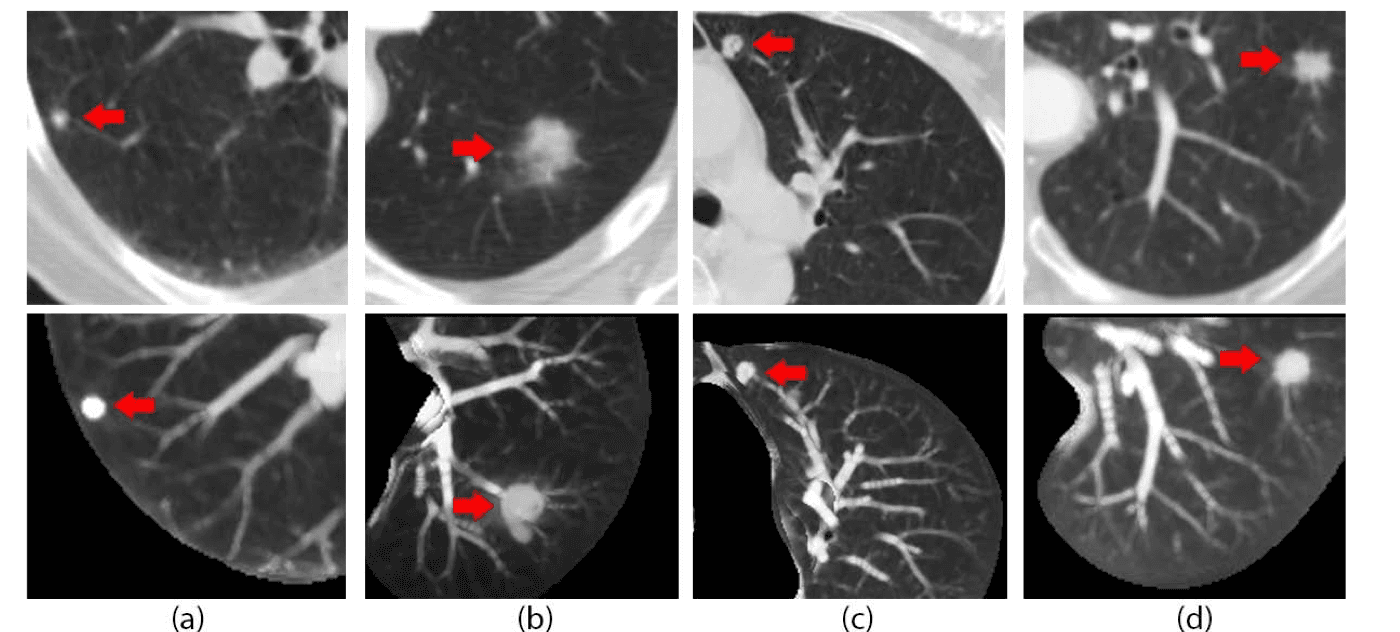 Chest CT examples with highlighted nodules